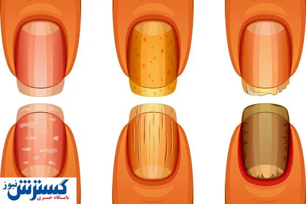 تشخیص سرطان ریه از روی ناخن ممکن شد تشخیص سرطان ریه از روی ناخن ممکن شد